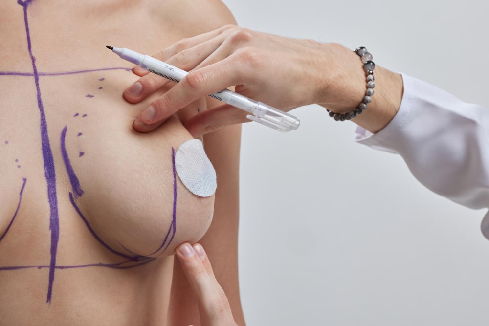 cirugía de areola tras mastectomía